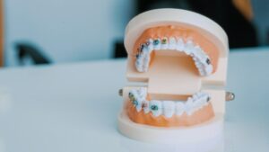 braces and teeth model