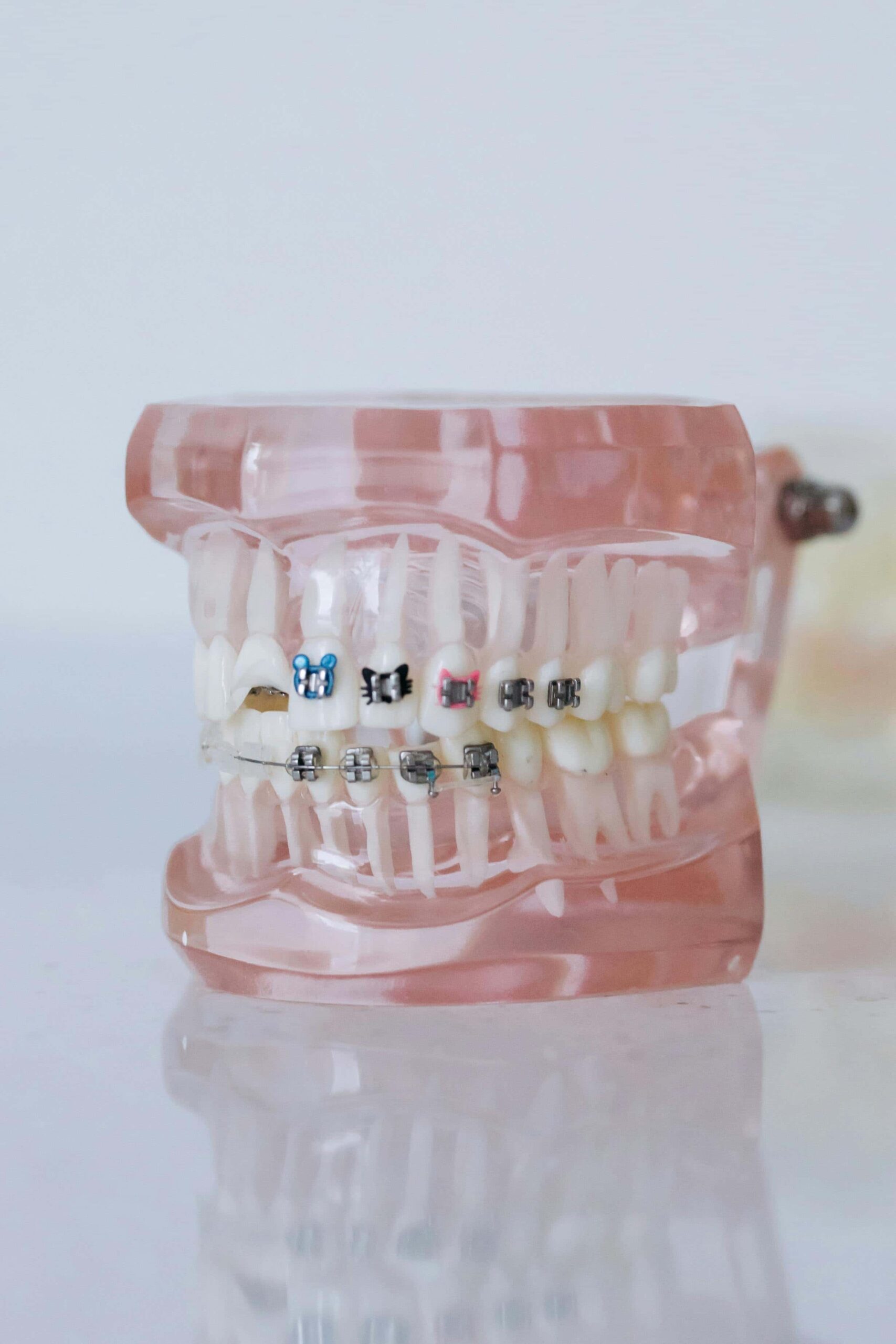 braces model